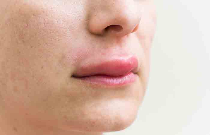 Primul plan al reacțiilor alergice pe buze ca efect secundar al steviei